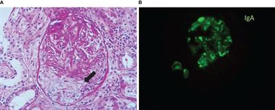 IgA-dominant postinfectious glomerulonephritis: a case report